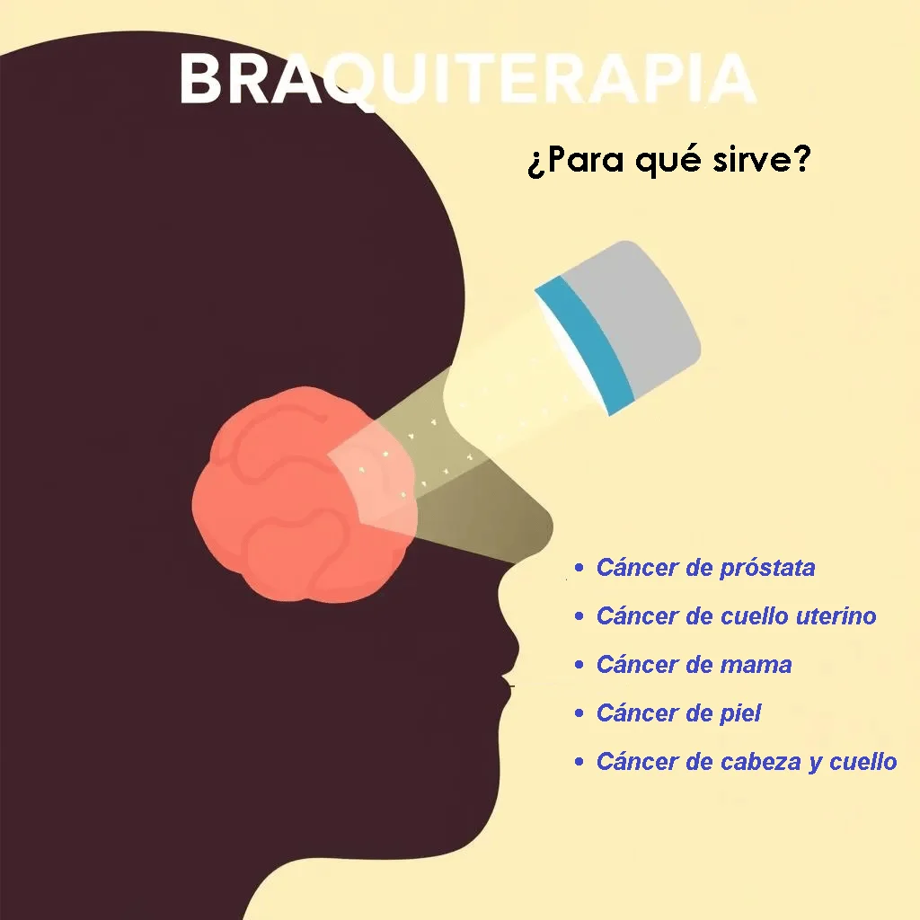 Braquiterapia para que sirve